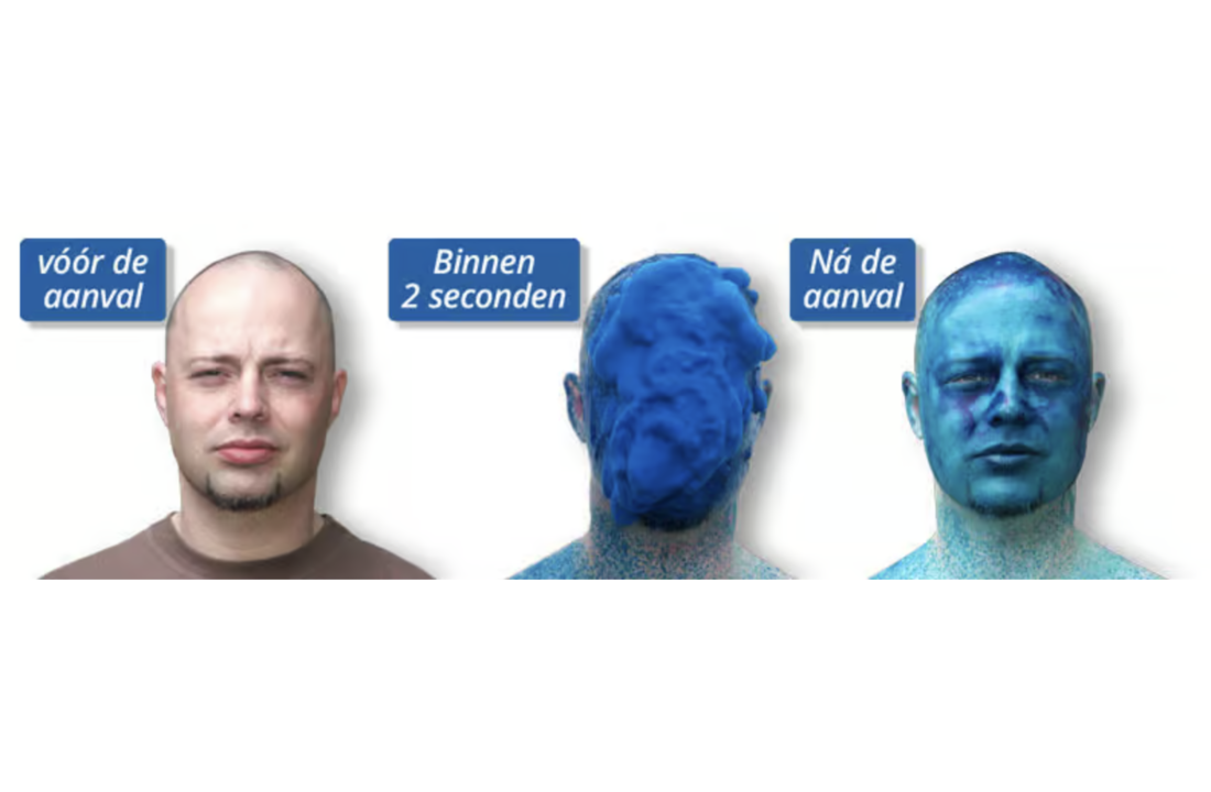 Voorbeeld effect van smurfenspray - duidelijke blauwe markering op huid die dagenlang zichtbaar blijft voor identificatie